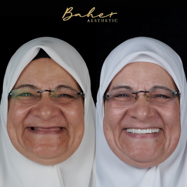 Before and after smile transformation in Egypt