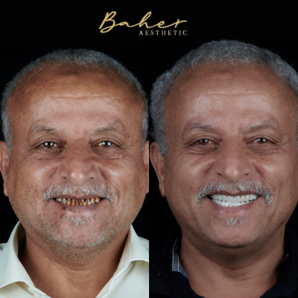 Best smile design transformation in Egypt