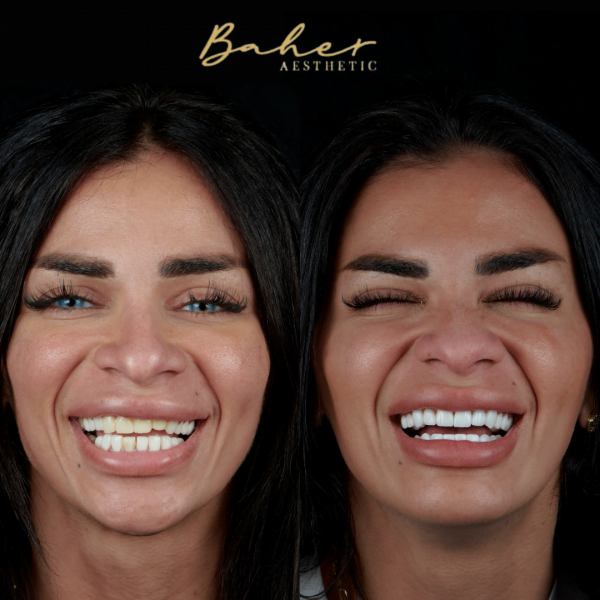 Smile makeover by Dr. Baher, the best dentist in Egypt