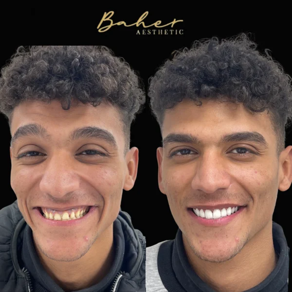 Smile transformation by best dentist in Egypt