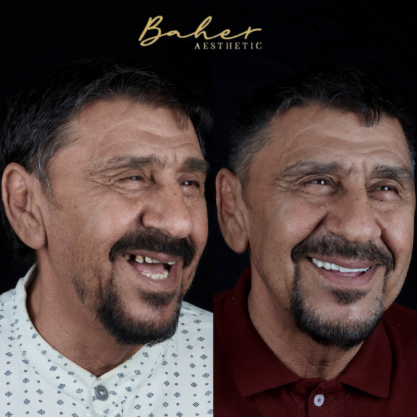 Before and after smile design by best dental doctor in Egypt