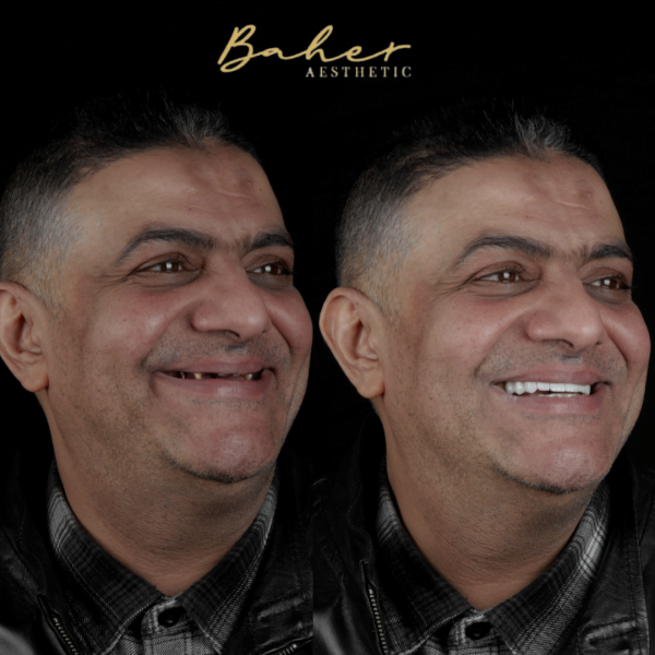 Best smile makeover in Egypt by Dr. Baher