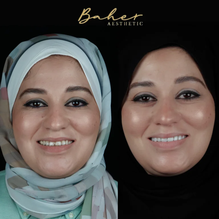 Smile transformation by the best dental doctor in Egypt