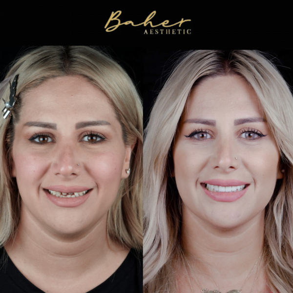 Smile makeover by best dental doctor in Egypt