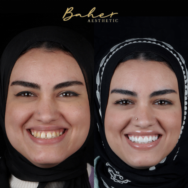 Best smile design in Egypt by Dr. Baher