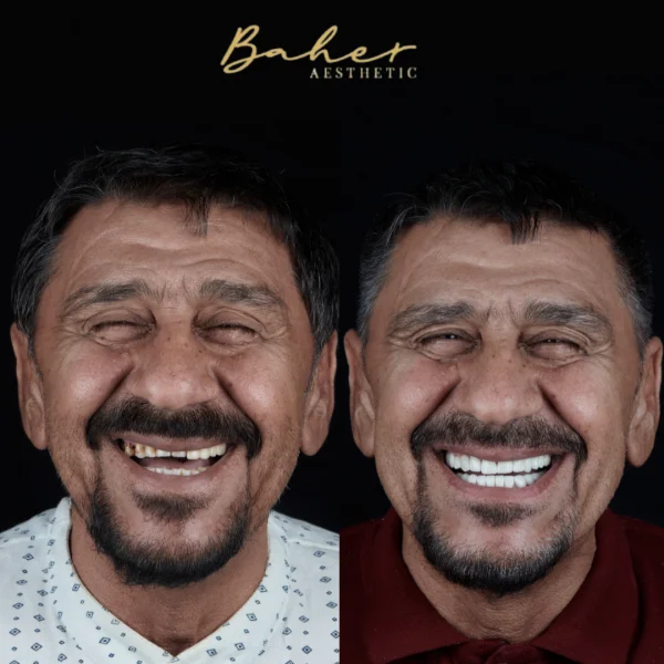 Perfect smile design by best dentist in Egypt
