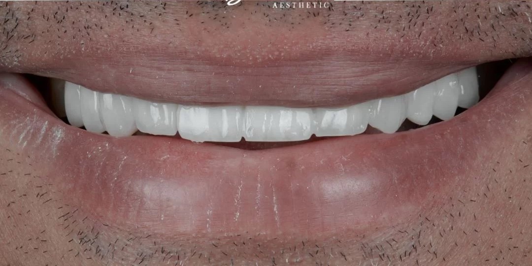 صورة بعد العلاج لابتسامة صحية ومشرقة بعد علاج شامل