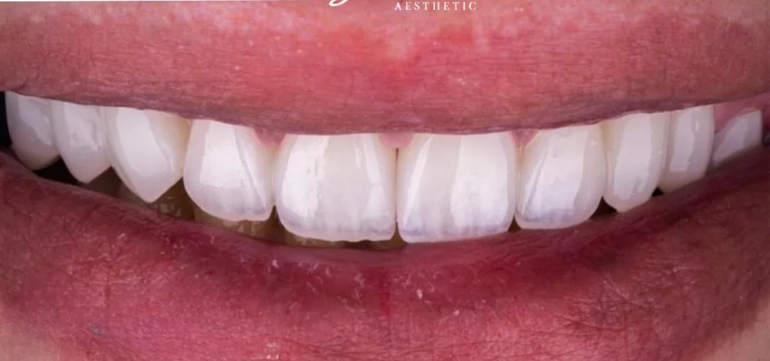 صورة بعد العلاج لأسنان محسنة وبيضاء
