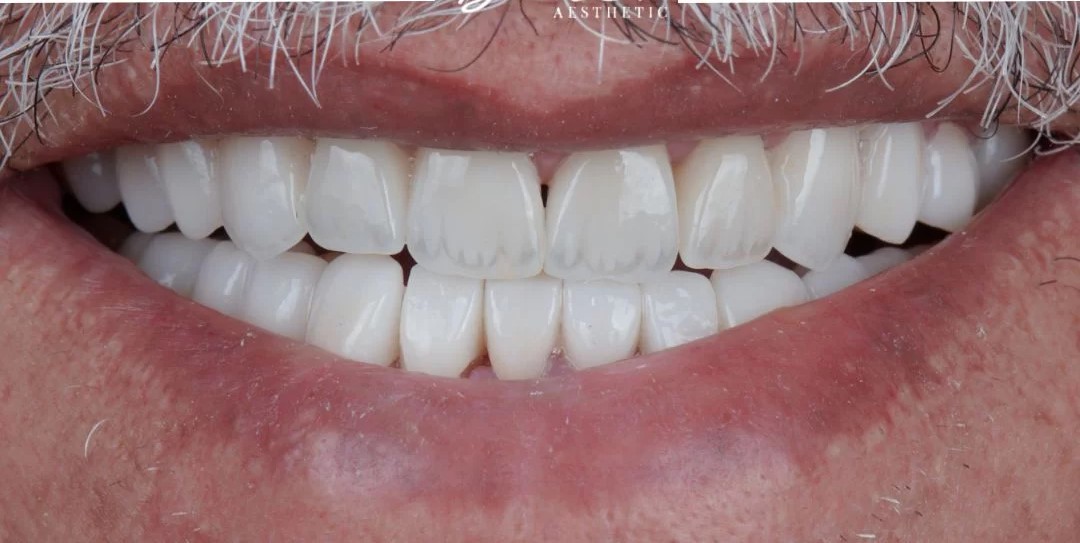 صورة بعد العلاج لأسنان بيضاء وصحية بعد الترميم