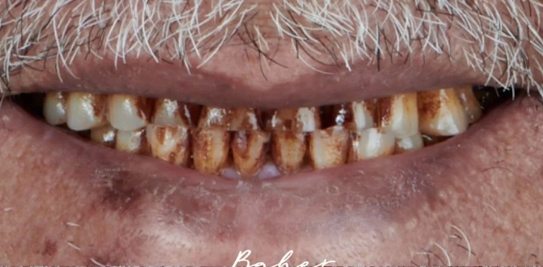 صورة قبل العلاج لمريض يعاني من فقدان وتلف الأسنان