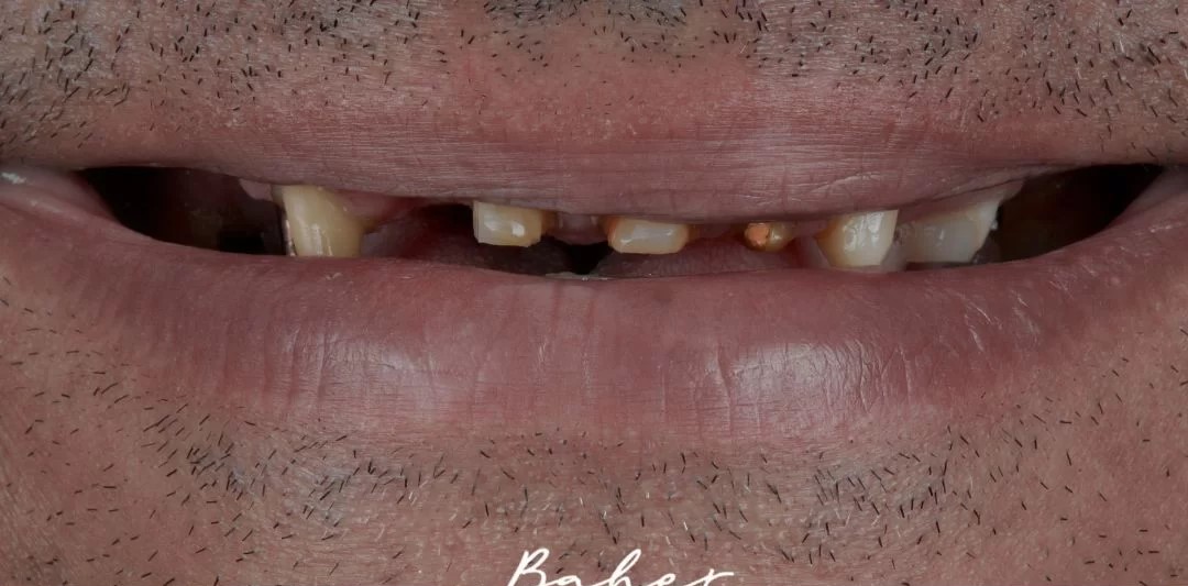 صورة قبل العلاج لأسنان متهالكة بشدة