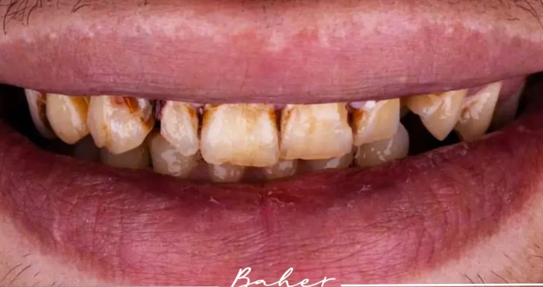 صورة قبل العلاج لمريض بأسنان صفراء ومتضررة